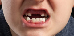bell-yard-10-reasons-to-choose-dental-implants-to-replace-lost-teeth