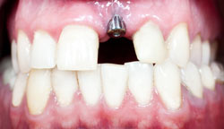 the-different-types-of-dental-implants